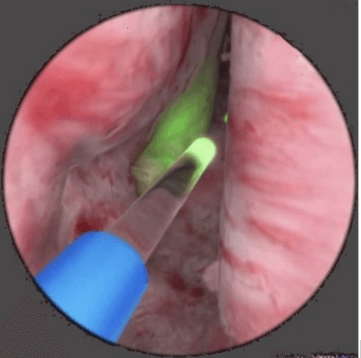HoLEP yöntemiyle iyi huylu prostat büyümesi ameliyatı