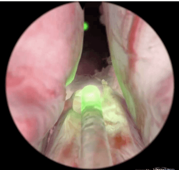 Yeşil Işık Lazer Tekniği ile prostat ameliyatı.